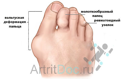 диагностика артрита пальцев ног