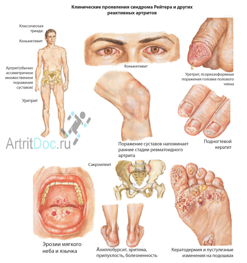 симптомы и виды артрита реактивного