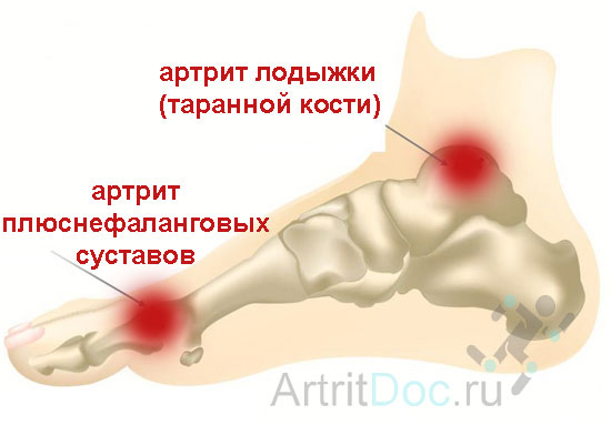 Артрозо артит последствия. Артрит и артроз: в чем разница, симптомы, лечение Артрозо-артрит - лечение, симптомы, причины, диагностика | Центр Дикуля Артрит и артроз : в чем разница, лечение, симптомы